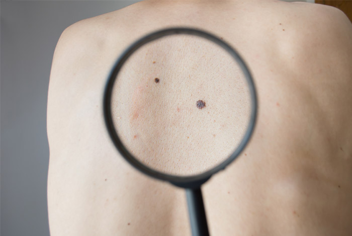 Melanoma Skin Cancer